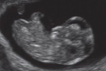 10 weeks pregnant scan