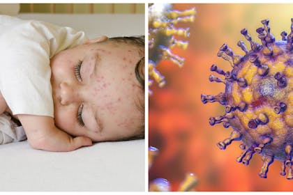 baby with chickenpox and chickenpox virus
