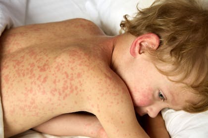 young boy with measles rash on his back
