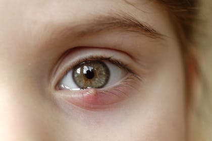 Child's eye with a stye