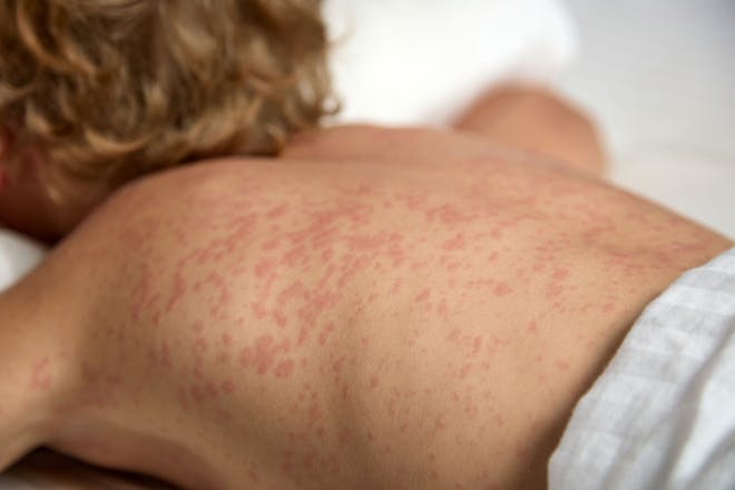 A child with measles, their back covered in a raised, red rash