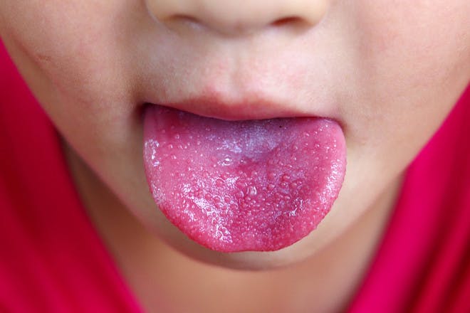 Scarlet Fever: Signs, Symptoms And Treatment - Netmums