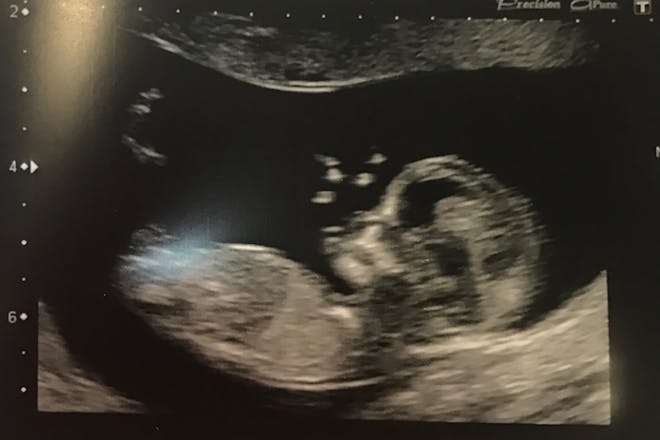 Photo of 12 week pregnancy anomaly scan
