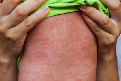 9. Measles rash
