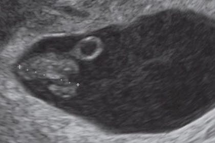 7 weeks pregnant scan