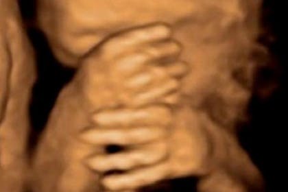 20 weeks pregnant scan