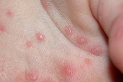 8. Hand, foot and mouth disease