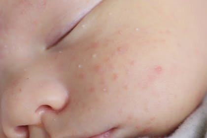 Baby with white spots on cheek called milia