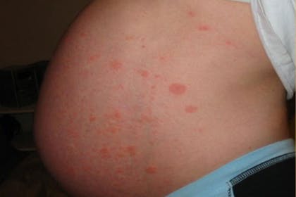pruritic urticarial papules and plaques of pregnancy or polymorphic eruption of pregnancy rash