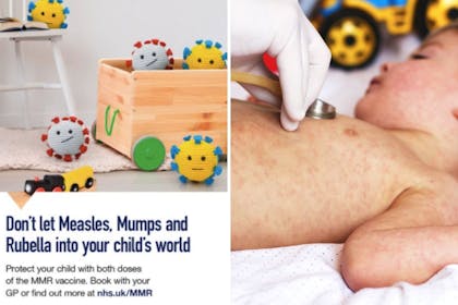 Left: measles graphicRight: Child with rash