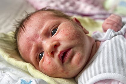 Newborn with baby acne (erythema toxicum) on face