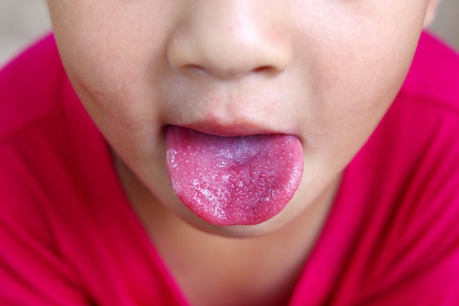 Boy with sore tongue