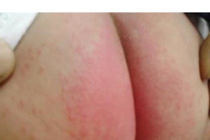 17. Nappy rash