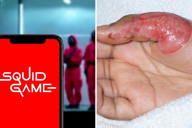 Left: Phone graphic saying Squid GameRight: Burnt hand