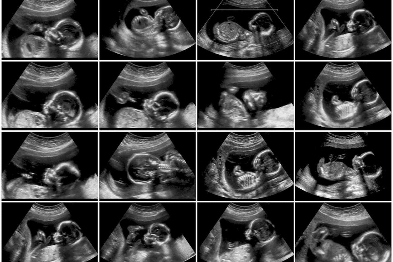 Ultrasound Scans In When Do you Have Them What Do Do? - Netmums