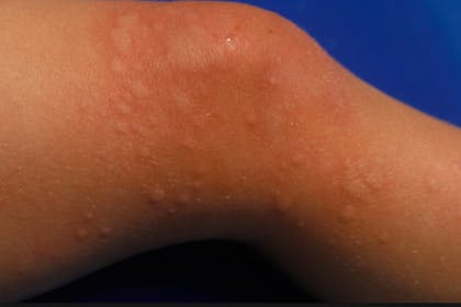 15. Skin allergy or hives