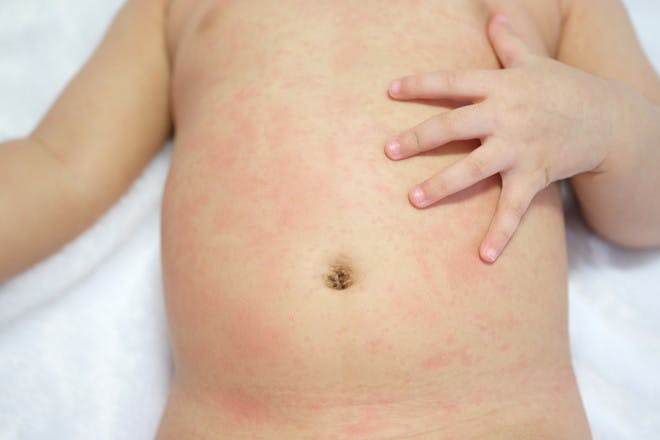 Treating A Fever In Babies And Children Netmums