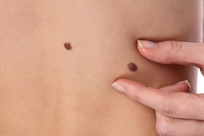 10. Changes in your child's moles