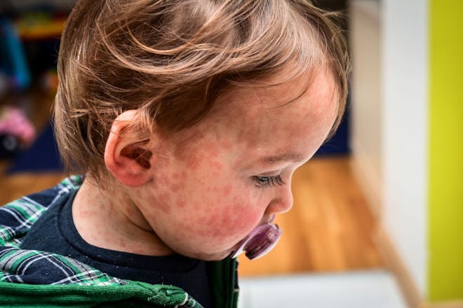 Measles on the face of a toddler