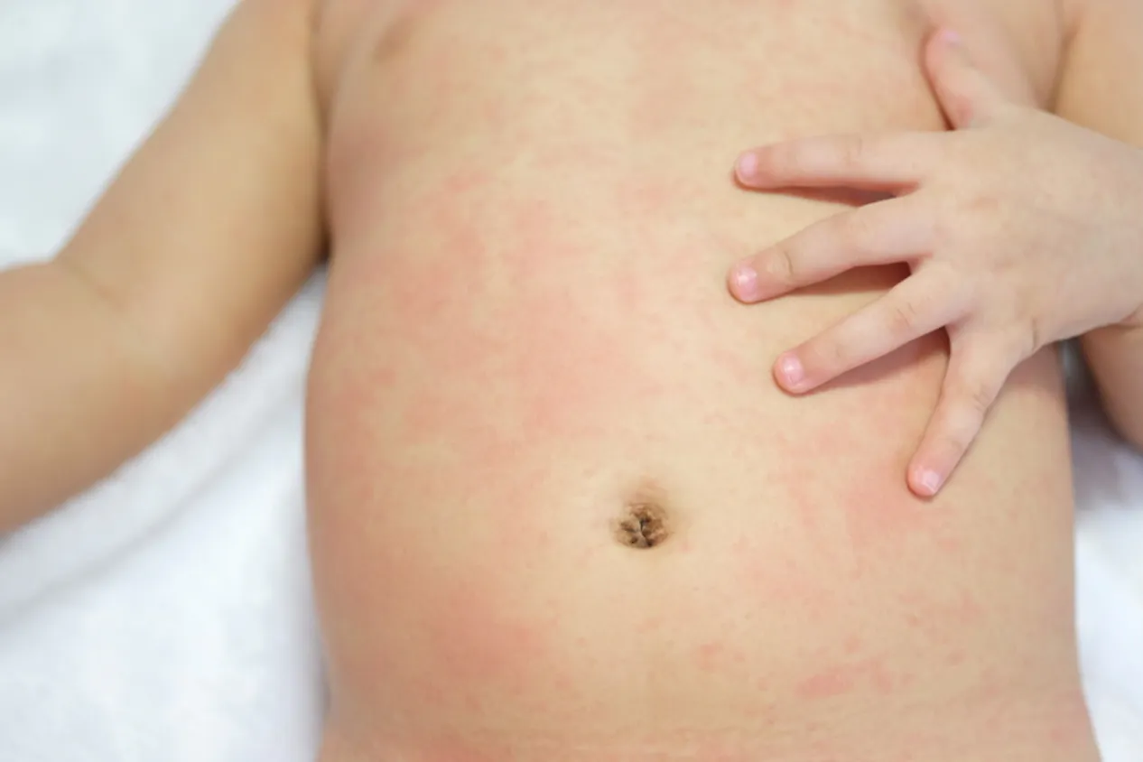 baby drool rash on stomach