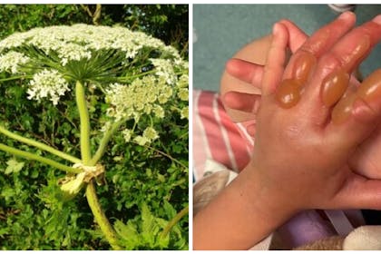 Giant hogweed | Child's burns from the plant