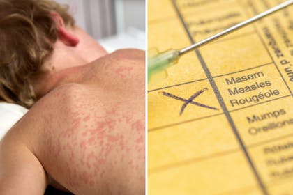 Boy with measles and measles on vacccination sheet