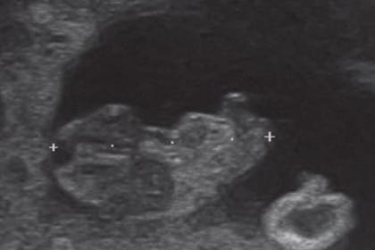 9 weeks pregnant scan