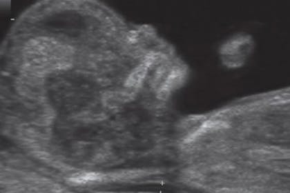 12 weeks pregnant scan
