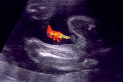 28 weeks pregnant scan