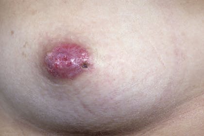 Paget's disease of the nipple rash