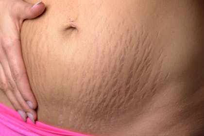 stretch marks caused by pregnancy