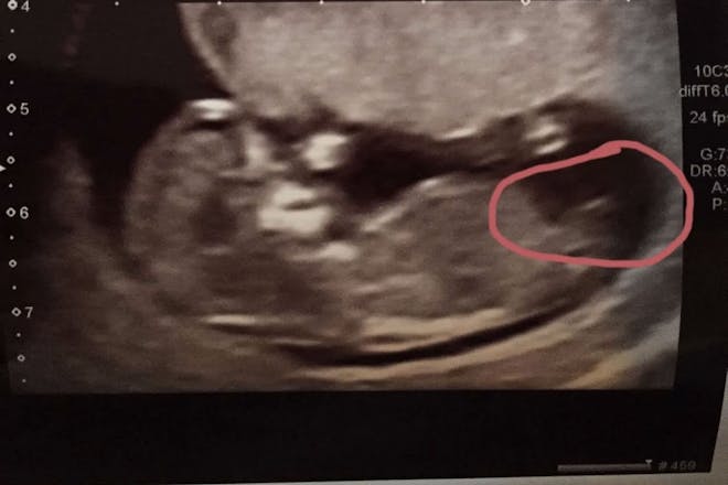 ultrasound scan showing highlighted nub for nub theory