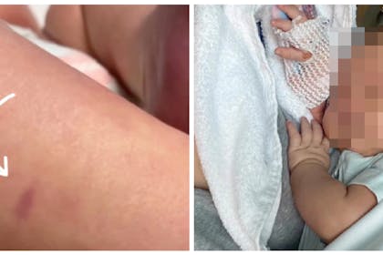 Baby rash / baby in hospital