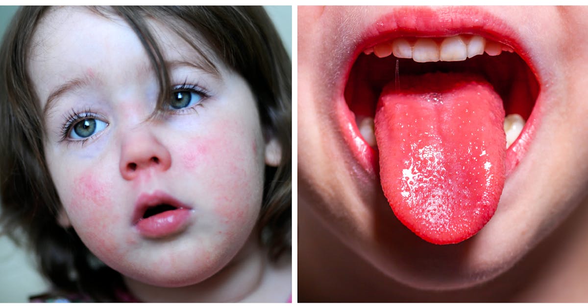 Warning For Parents As Cases Of Victorian Disease 'Unseasonably High In  Kids' - Netmums