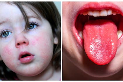 Child with flushed face / Scarlet fever tongue