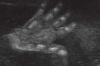 24 weeks pregnant scan