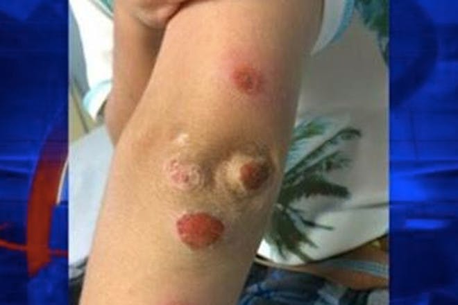 Mum Issues Bouncy Castle Warning After Son Develops Oozing Sores