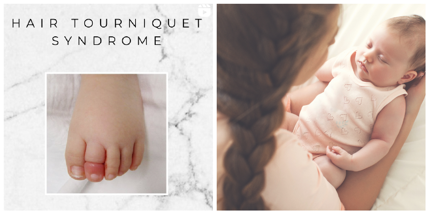 Doctor Warns Parents About 'Hair Tourniquet' Condition in Babies and ...