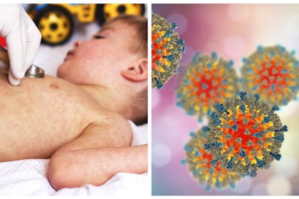 Child with measles / measles