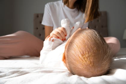 Baby with cradle cap (seborrhoeic dermatitis)