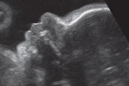 33 weeks pregnant scan
