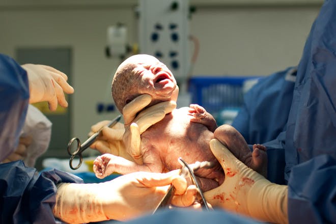 A baby born via caesarean 