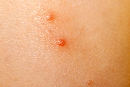 Molluscum contagiosum (water warts) spots