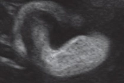 34 weeks pregnant scan