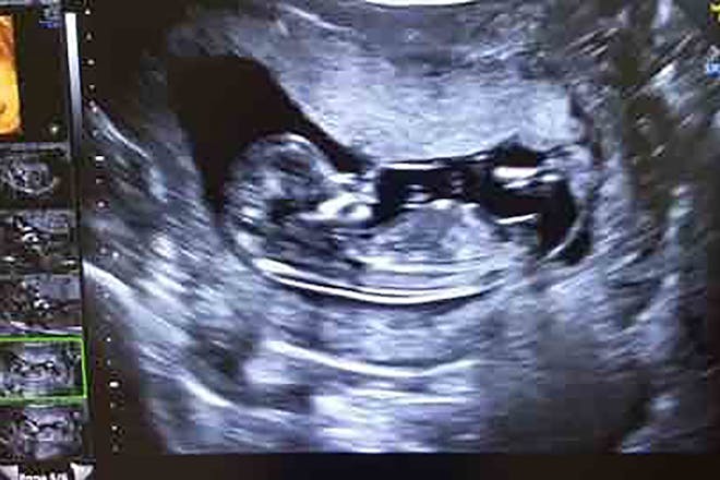 Photo of a 12 week pregnancy baby scan