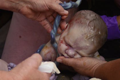 Incredible photos of vaginal breech birth