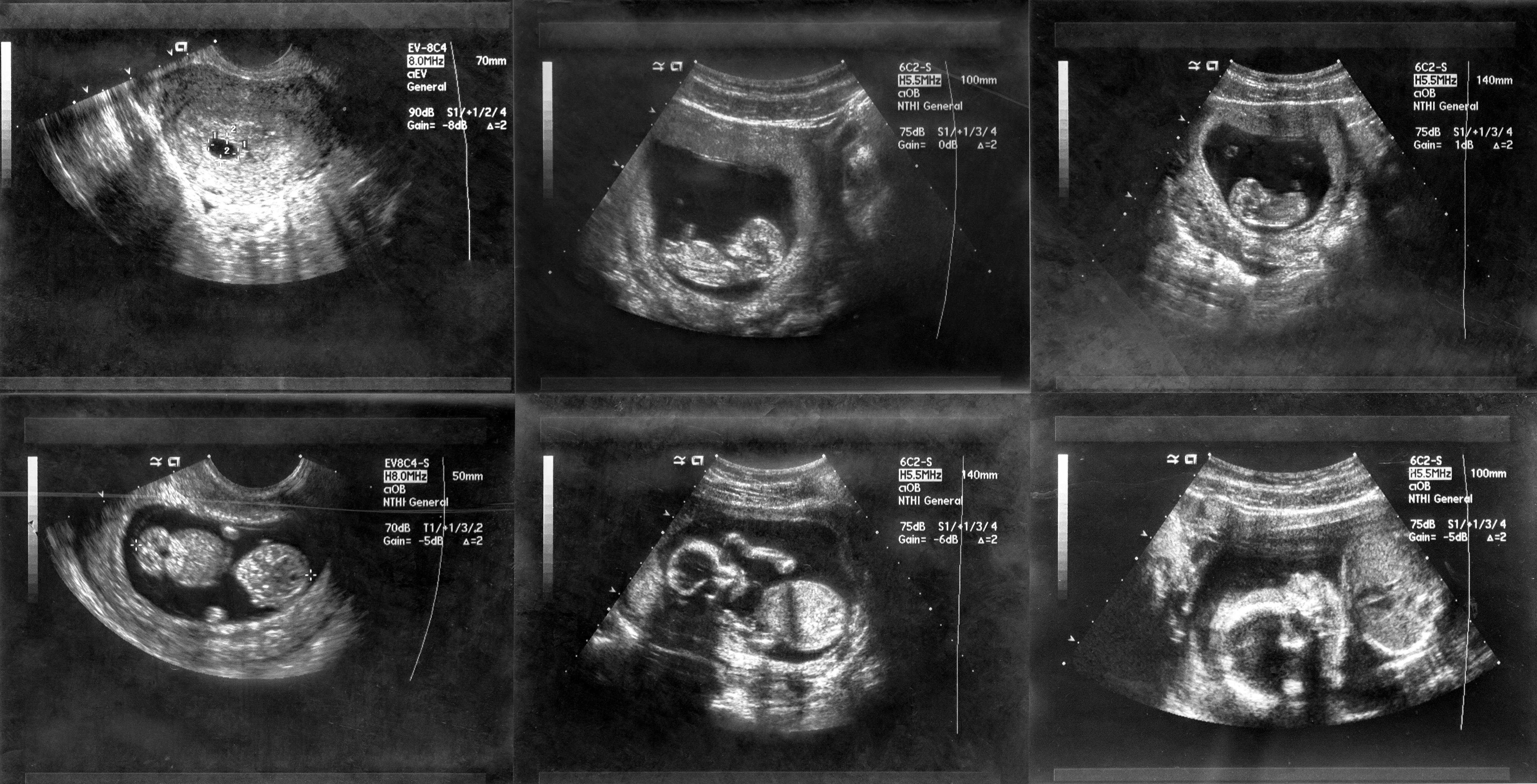 41 Weeks Pregnant Ultrasound 