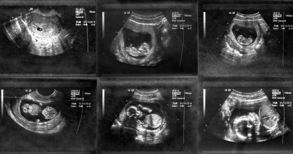 Weekbyweek pregnancy scan photos Netmums