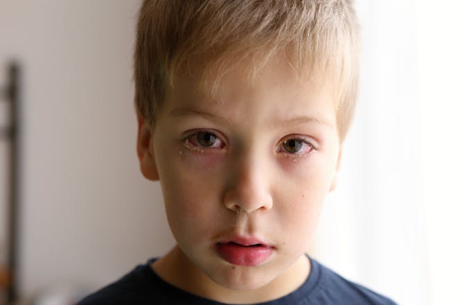 Boy with conjunctivitis 