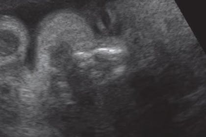 31 weeks pregnant scan